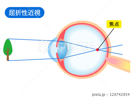 目の構造　屈折性近視　視力 128742854