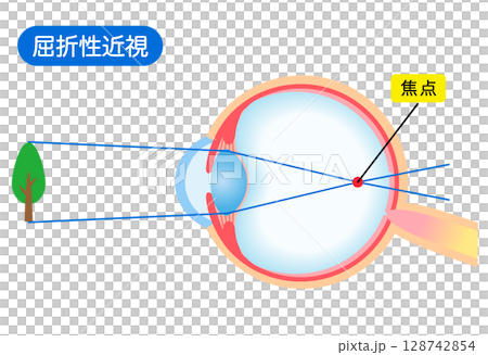 目の構造　屈折性近視　視力 128742854