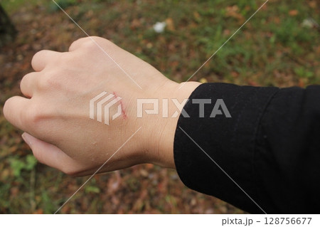 Close up scratch on hand of the back of a young woman's girl's hand. Skin injuries 128756677