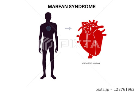 Marfan syndrome poster 128761962