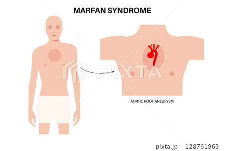 Marfan syndrome poster Marfan syndrome poster 128761963