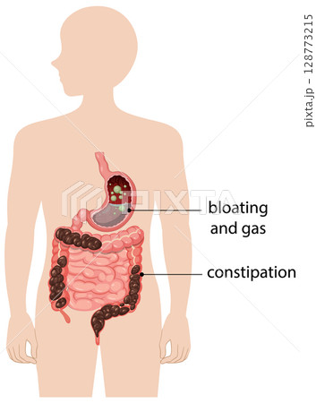 Human Digestive System with Bloating and Constipation 128773215