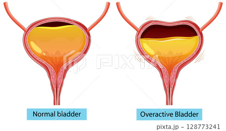 Comparison of Normal and Overactive Bladder Comparison of Normal and Overactive Bladder 128773241