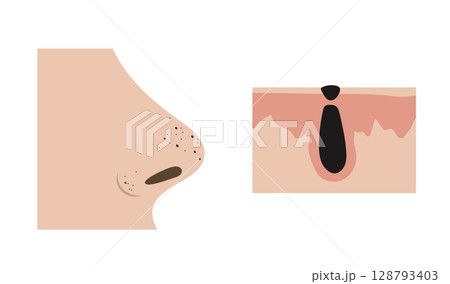 Blackheads clogging pores on nose and anatomical detail of comedo formation Blackheads clogging pores on nose and anatomical detail of comedo formation 128793403