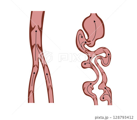 Normal Veins and Varicose Veins Showing Blood Flow Normal Veins and Varicose Veins Showing Blood Flow 128793412