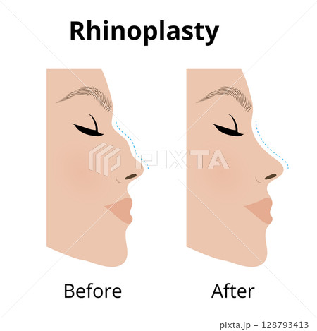 Rhinoplasty, woman showing nose before and after cosmetic surgery 128793413