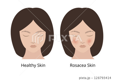 Woman showing rosacea skin and healthy skin comparison 128793414