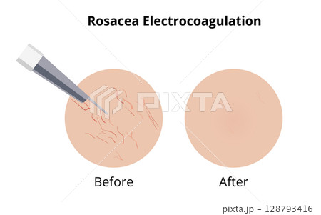 Electrocoagulation removing rosacea couperose veins before and after treatment Electrocoagulation removing rosacea couperose veins before and after treatment 128793416