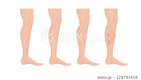 Stages of varicose veins developing on human leg 128793419
