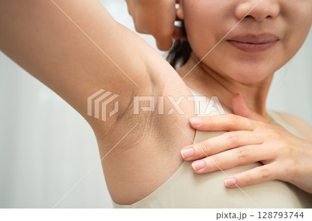 Asian woman have problem black armpit beauty skin care. 128793744