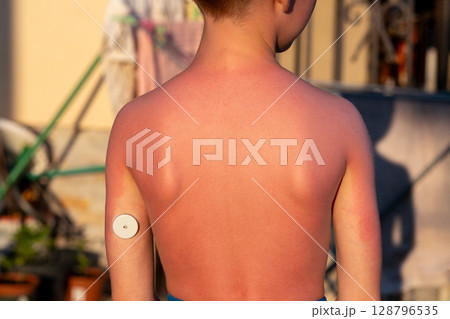 Child with sunburned back and glucose monitor standing outdoors in summer light Child with sunburned back and glucose monitor standing outdoors in summer light 128796535