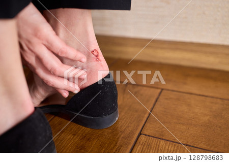 A Foot Injury That Resulted from Wearing Uncomfortable and Poorly Designed Shoes 128798683