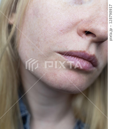 A dermatologist examines a woman's face with dilated pores, pigmentation, and sebaceous filaments. Treatment of rosacea and skin inflammation. A dermatologist examines a woman's face with dilated pores, pigmentation, and sebaceous filaments. Treatment of rosacea and skin inflammation. 128798917