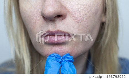 A dermatologist examines a woman's face with dilated pores, pigmentation, and sebaceous filaments. Treatment of rosacea and skin inflammation. A dermatologist examines a woman's face with dilated pores, pigmentation, and sebaceous filaments. Treatment of rosacea and skin inflammation. 128798922