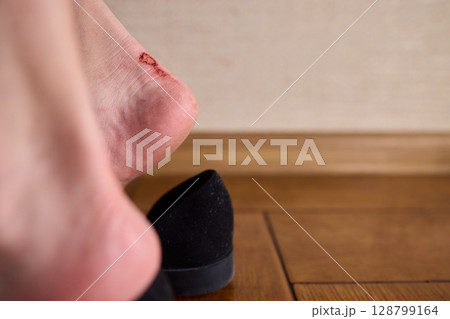 A Foot Injury That Resulted from Wearing Uncomfortable and Poorly Designed Shoes 128799164