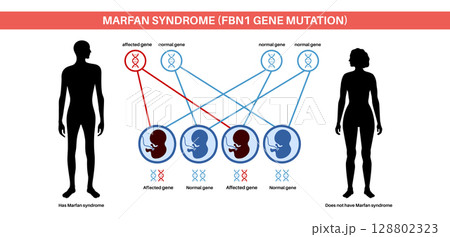 Marfan syndrome poster Marfan syndrome poster 128802323