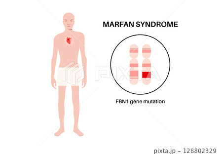 Marfan syndrome poster 128802329
