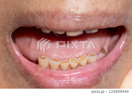 Attrition tooth due to interaction with other teeth in elderly woman. 128809440