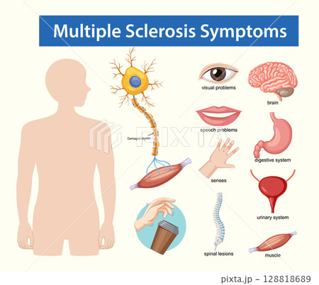 Multiple Sclerosis Symptoms Medical Vector Illustration 128818689