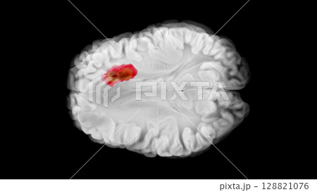 Frontal Lobe Glioblastoma in Axial Brain View 128821076