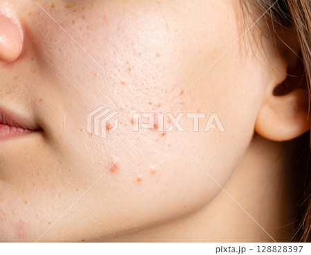 ニキビがでている女性の顔 128828397