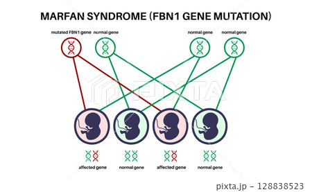 Marfan syndrome poster Marfan syndrome poster 128838523
