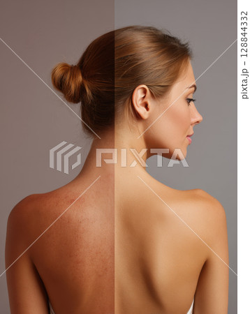 A striking visual comparison showing a woman's back, half with skin imperfections and half with clear, healthy skin. Perfect for dermatology, beauty, and skincare advertising 128844332