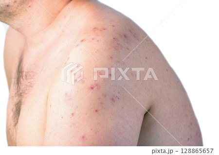 Red spots and rashes on the skin of a man s shoulders due to a reaction to alcohol. Alcohol intolerance, enzyme deficiency, allergies, close-up 128865657