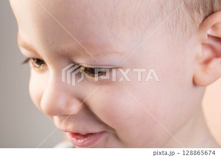 Little boy with pus in his eyes, the boy's disease is bacterial conjunctivitis. Viral infection in the eyes, close-up 128865674