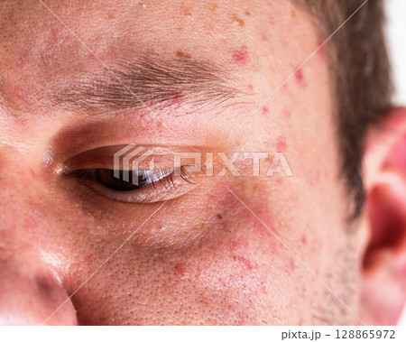 Red spots and rashes on the scalp and eyes. Alcohol intolerance, alcoholic urticaria, allergies, close-up 128865972