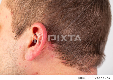 Red rashes and spots on the ears and head of a man after drinking alcohol. Alcoholic dermatitis and urticaria. Allergy to alcohol. 128865973