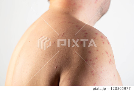 Red spots and rashes on the skin of a man s shoulders due to a reaction to alcohol. Alcohol intolerance, enzyme deficiency, allergies, close-up Red spots and rashes on the skin of a man s shoulders due to a reaction to alcohol. Alcohol intolerance, enzyme deficiency, allergies, close-up 128865977