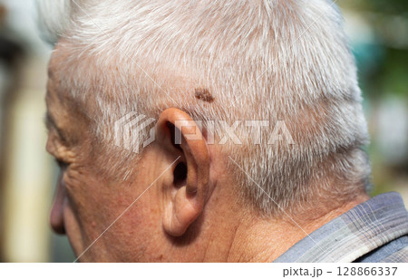 Brown mole on the head of an elderly person, nevus and melanoma, close-up, dermatology 128866337
