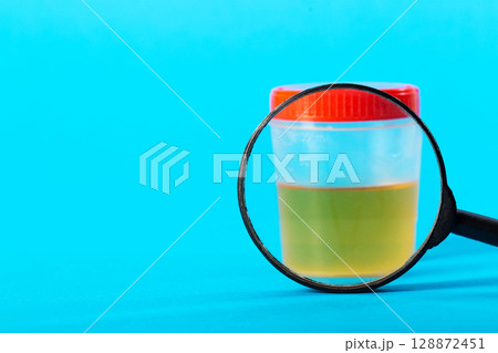 Container with urine test under a magnifying glass on a blue background. Hematuria and protein in the urine. Prostatitis and cystitis in urology. Copy space for text, escherichia coli 128872451