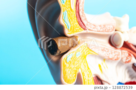 Earwax plug in the ear canal of the ear model, close-up. Copy space for text Earwax plug in the ear canal of the ear model, close-up. Copy space for text 128872539