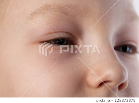 The girl has swollen, reddened, painful eyes. Inflammation of conjunctivitis, pus in the eyes. Bacterial infection, close-up The girl has swollen, reddened, painful eyes. Inflammation of conjunctivitis, pus in the eyes. Bacterial infection, close-up 128872879
