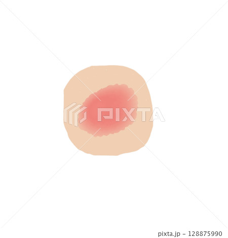 発赤｜皮膚の炎症イラスト素材（透過PNG）Erythema Skin Condition Illus 128875990