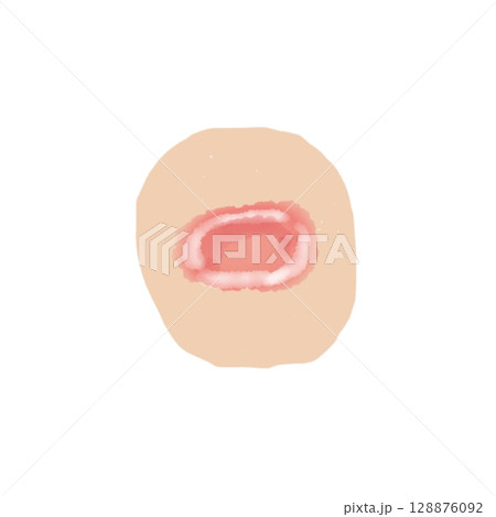 びらん｜皮膚表面の浅い欠損イラスト素材（透過PNG）Erosion Skin Illustratio 128876092