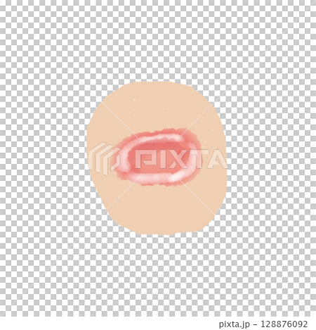 びらん｜皮膚表面の浅い欠損イラスト素材（透過PNG）Erosion Skin Illustratio 128876092