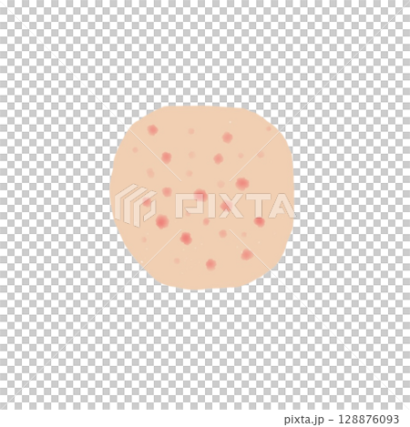 発疹｜皮膚に現れる点状変化のイラスト素材（透過PNG）Rash Skin Illustration 128876093