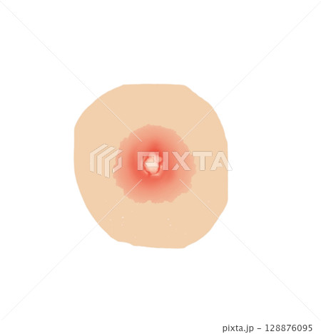 膿瘍｜皮下に膿がたまった状態のイラスト素材（透過PNG）Abscess Medical Illust 128876095