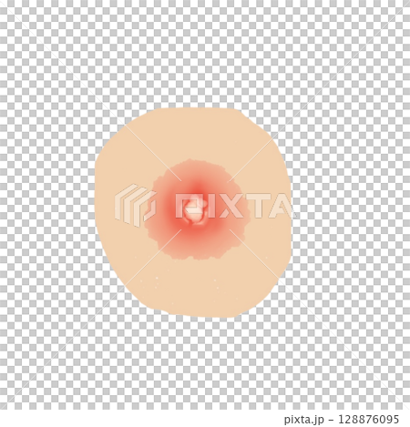 Abscess | Illustration of a state in which pus accumulates under the skin (transparent PNG) Abscess Medical Illust Abscess | Illustration of a state in which pus accumulates under the skin (transparent PNG) Abscess Medical Illust 128876095