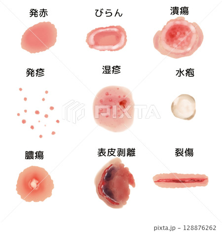 皮膚病変イラストセット｜発赤・びらん・潰瘍など9種（透過PNG）Skin Lesion Illust 128876262
