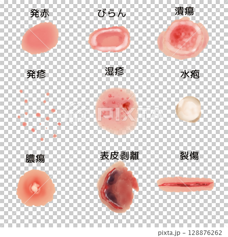 皮膚病變插圖集 | 發紅、糜爛、潰瘍等9種(透明PNG)皮膚病變插圖 皮膚病變插圖集 | 發紅、糜爛、潰瘍等9種(透明PNG)皮膚病變插圖 128876262