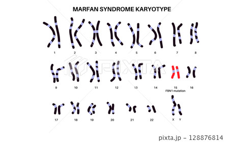 Marfan syndrome poster 128876814