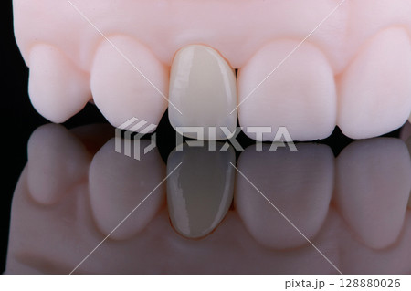 Lateral maxillary incisor made of zirconium, ultra thin dental ceramic veneer crown on printed model 128880026