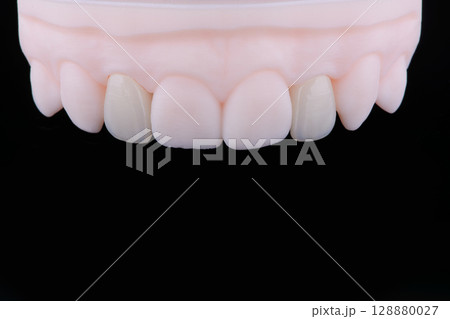 High-quality dental single crowns made of zirconium for fixation to the frontal teeth of upper jaw. 128880027