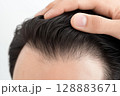 男性の頭皮と生え際をクローズアップで撮影した薄毛治療イメージ 128883671