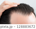 男性の頭皮と生え際をクローズアップで撮影した薄毛治療イメージ 128883672