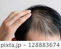 男性の頭皮と生え際をクローズアップで撮影した薄毛治療イメージ 128883674